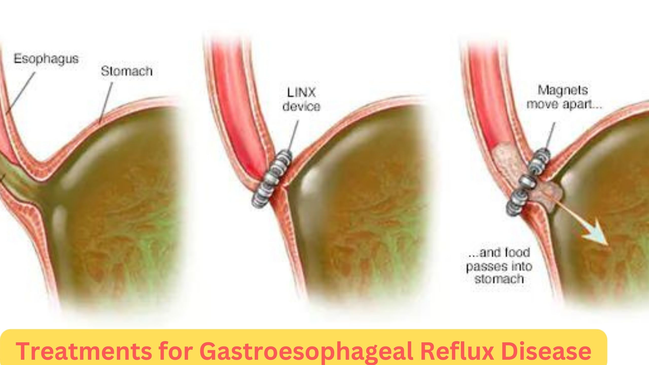 Treatments for Gastroesophageal Reflux Disease (GERD)